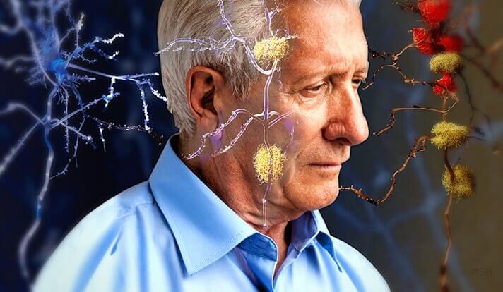 umh. investigadores identifican marcador temprano del alzheimer