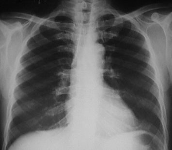 cátedra de investigación de las enfermedades pulmonares