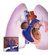 hipertensión arterial pulmonar hereditaria