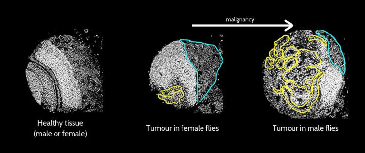Identifican genes relacionados con el diferente grado de agresividad del cáncer según el sexo