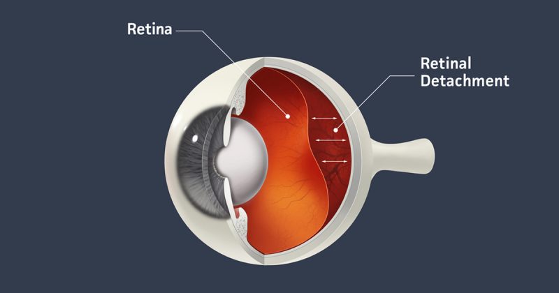 ucm ,qué zonas de la retina cambian con alzhéimer leve