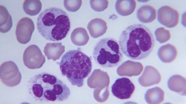 Características leucemia