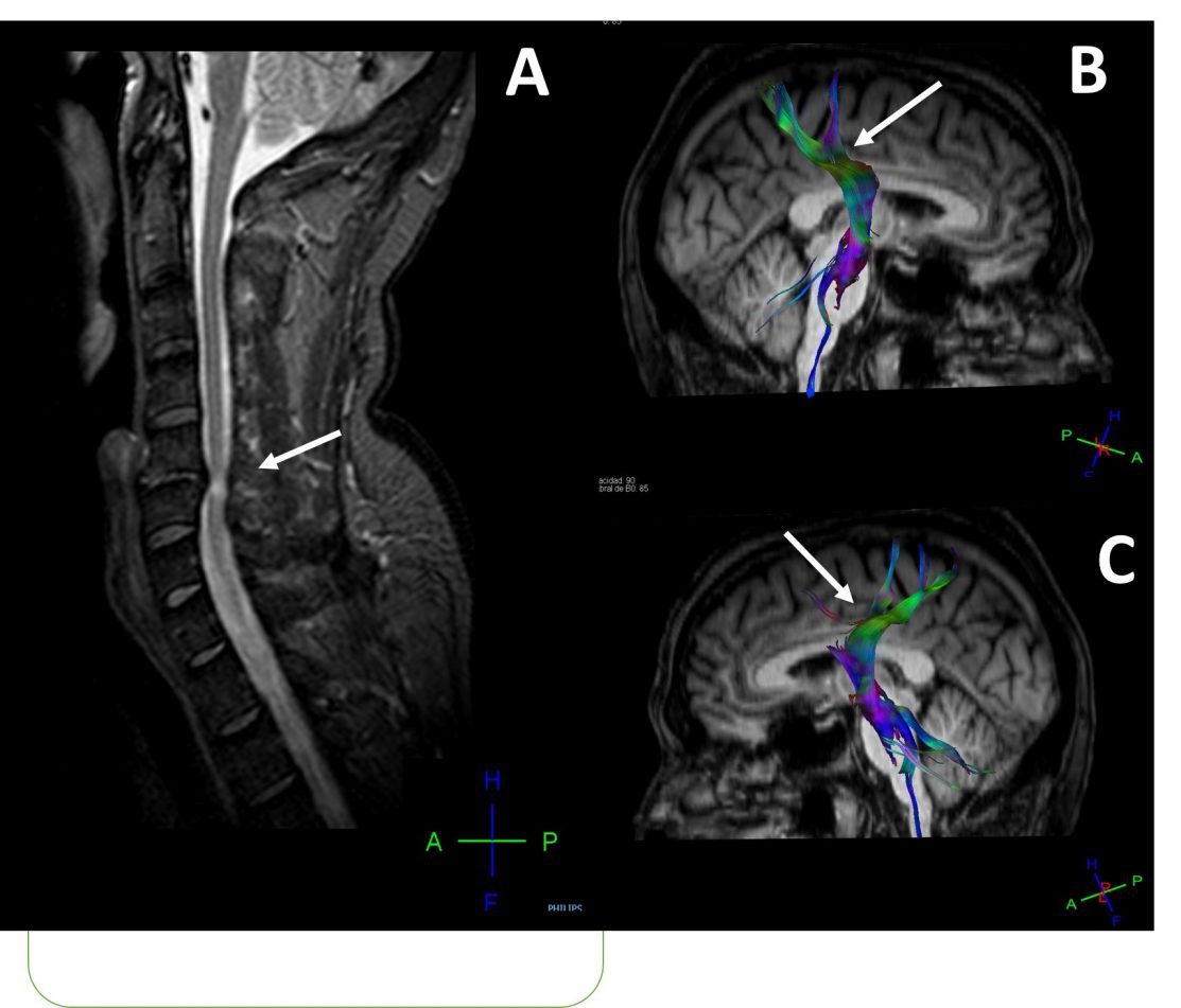 detectan daño cerebral en pacientes con hernias cervicales mediante técnicas de neuroimagen e inteligencia artificial