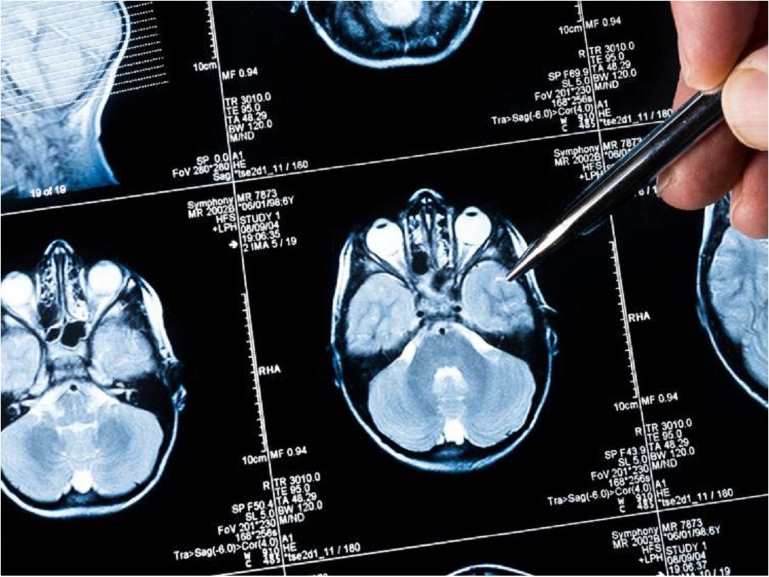 plataforma para investigación metástasis cerebral