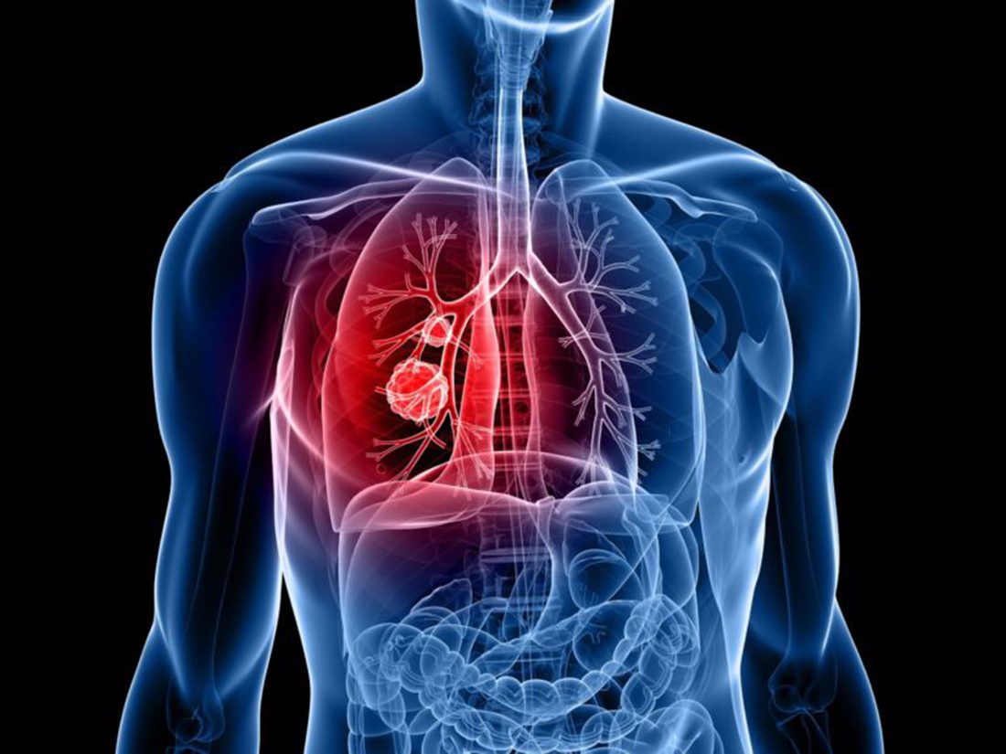 el cambio que hace “curable” un cáncer de pulmón