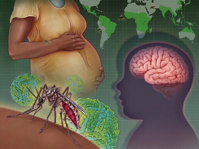 porqué el zika causa microcefalia en el feto