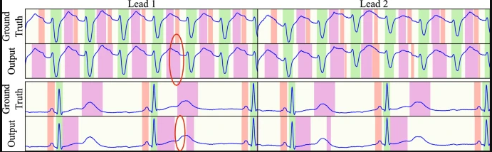 upf, algoritmo que automatiza los registros de los electrocardiogramas