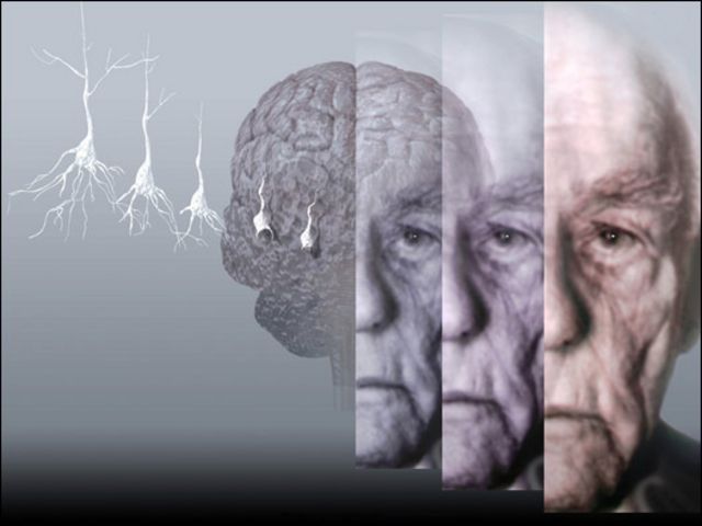 Un fármaco revierte los síntomas del alzhéimer 
