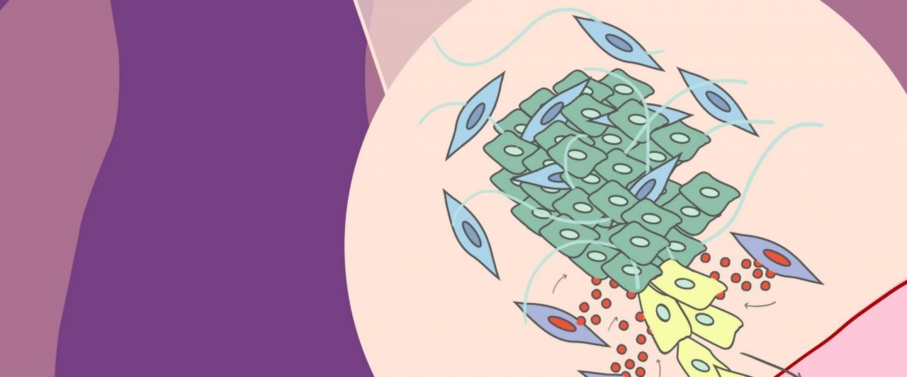 Un gen presente en las células que rodean los tumores es clave en la progresión del cáncer de mama