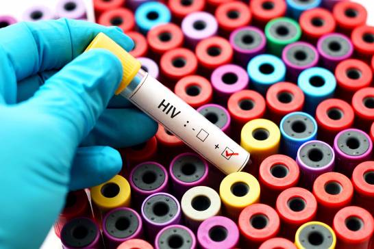 Identifican un segundo paciente con VIH cuyo cuerpo parece haber suprimido el virus