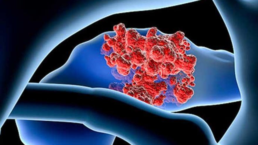 Ilustracion que refleja la formacion de un cancer de pancreas GETTY IMAGES
