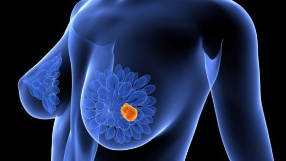 Combinar vacunas y quimioterapia elimina cancer mama
