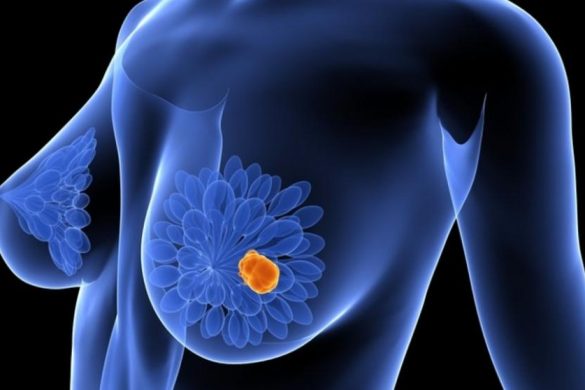 Combinar vacunas y quimioterapia elimina cancer mama