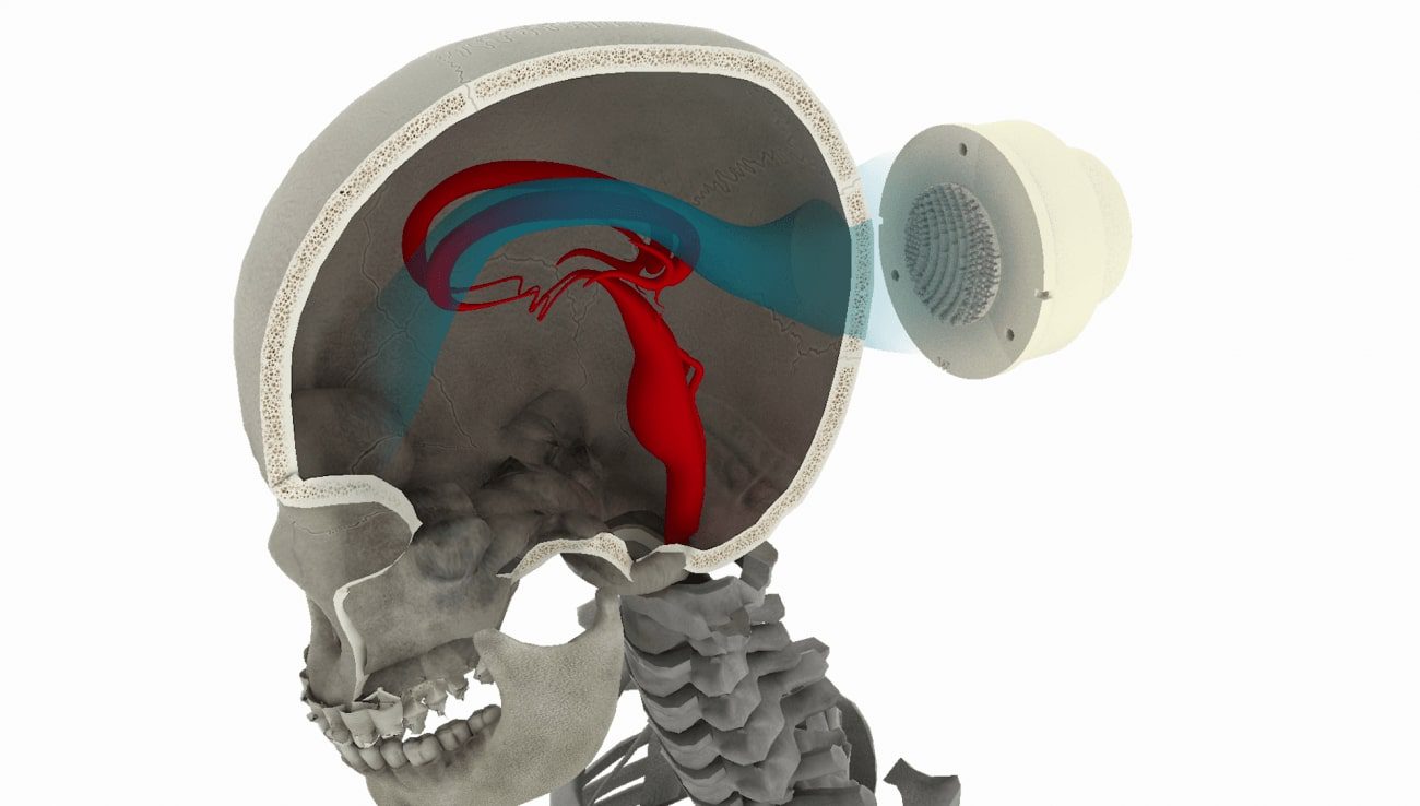 Hologramas 3D tratan enfermedades sistema nervioso