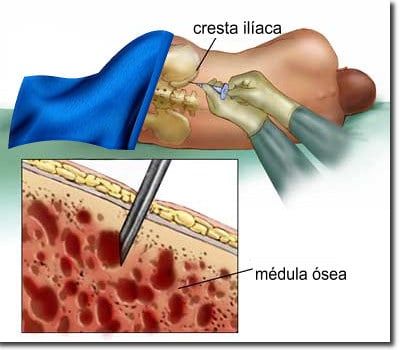 biopsia de medula osea
