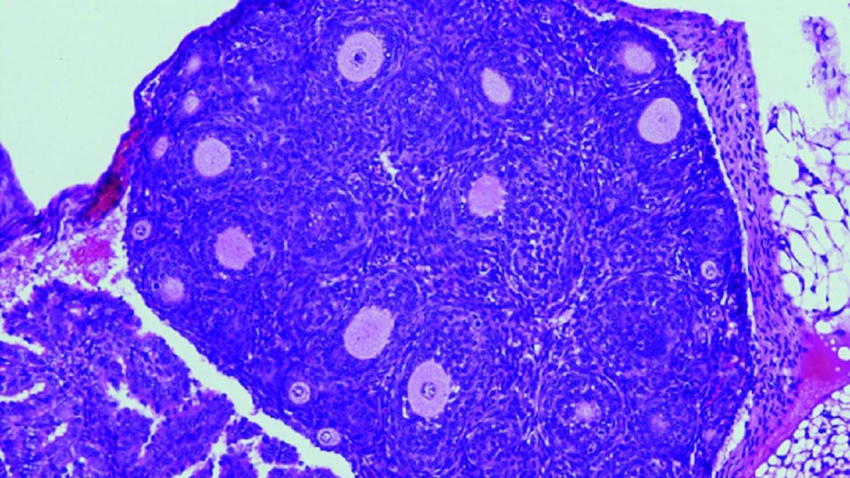 Un solo gen desarrolla cancer de ovarios1