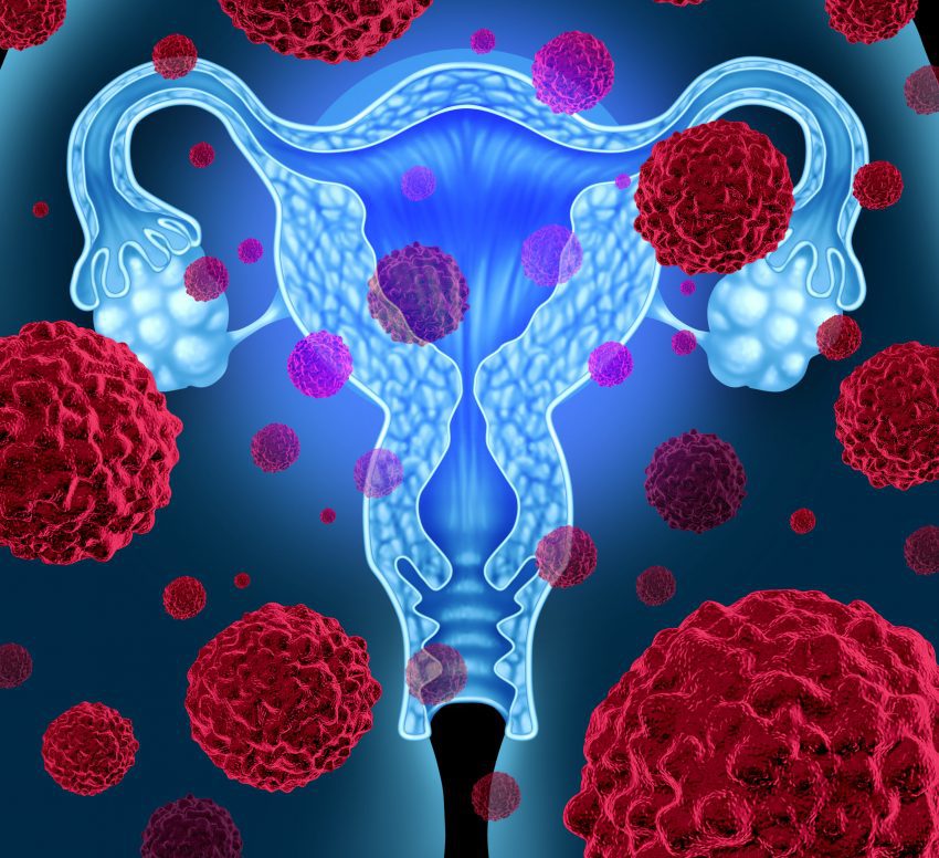Un solo gen desarrolla cancer de ovarios4
