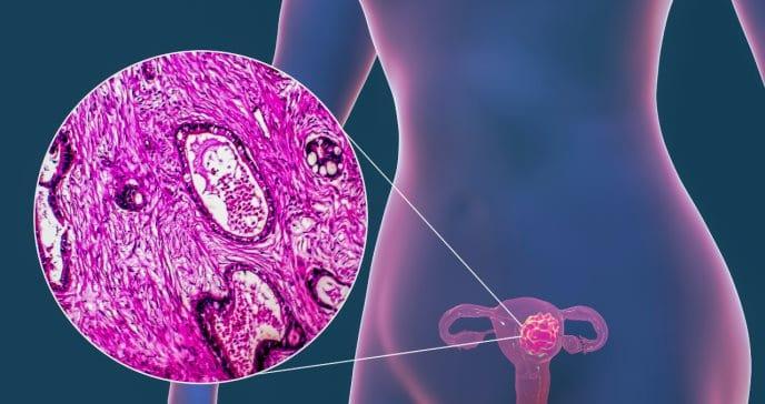 Un solo gen desarrolla cancer de ovarios5