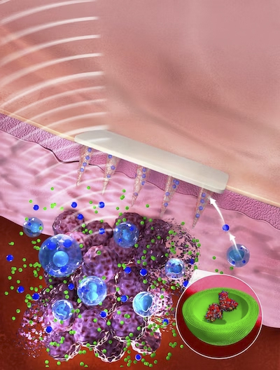 Moviendo la aguja en el seguimiento del cáncer de piel